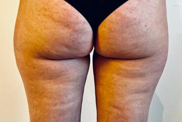 Cuppen voor Soepele Benen: Ontdek de Voordelen