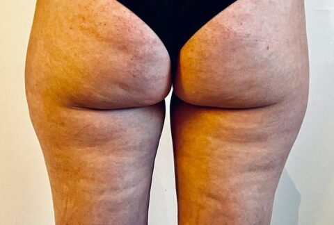 cupping, cellulitis, bindweefselmassage, transformeren, therapie, ontspanning, gezondheid, wellness, lichaamsbehandeling, zelfzorg, holistisch, spieren, rugpijn, nekpijn, stress, sportprestaties, genezing, acupunctuur, traditionele Chinese geneeskunde, energiestroom, littekens, bloedcirculatie, gifstoffen, immuunsysteem, verjonging, herstel, doorbloeding, massage, ontgifting, meridianen, ontsteking, pijnverlichting, alternatieve geneeskunde, natuurlijke genezing, helende kracht, chronische pijn, gezonde huid, vermoeidheid, slaapstoornissen, fibromyalgie, gewrichtspijn, menstruatiekrampen, spijsverteringsproblemen, hoofdpijn, migraine, allergieën, ademhaling, mindfulness, ontspanningstechnieken, meditatie, wellnesscentrum, cupping barneveld,benen