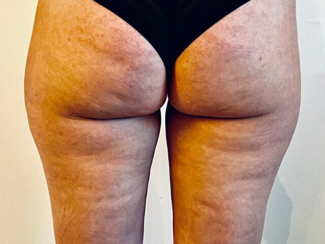 cupping, cellulitis, bindweefselmassage, transformeren, therapie, ontspanning, gezondheid, wellness, lichaamsbehandeling, zelfzorg, holistisch, spieren, rugpijn, nekpijn, stress, sportprestaties, genezing, acupunctuur, traditionele Chinese geneeskunde, energiestroom, littekens, bloedcirculatie, gifstoffen, immuunsysteem, verjonging, herstel, doorbloeding, massage, ontgifting, meridianen, ontsteking, pijnverlichting, alternatieve geneeskunde, natuurlijke genezing, helende kracht, chronische pijn, gezonde huid, vermoeidheid, slaapstoornissen, fibromyalgie, gewrichtspijn, menstruatiekrampen, spijsverteringsproblemen, hoofdpijn, migraine, allergieën, ademhaling, mindfulness, ontspanningstechnieken, meditatie, wellnesscentrum, cupping barneveld,benen