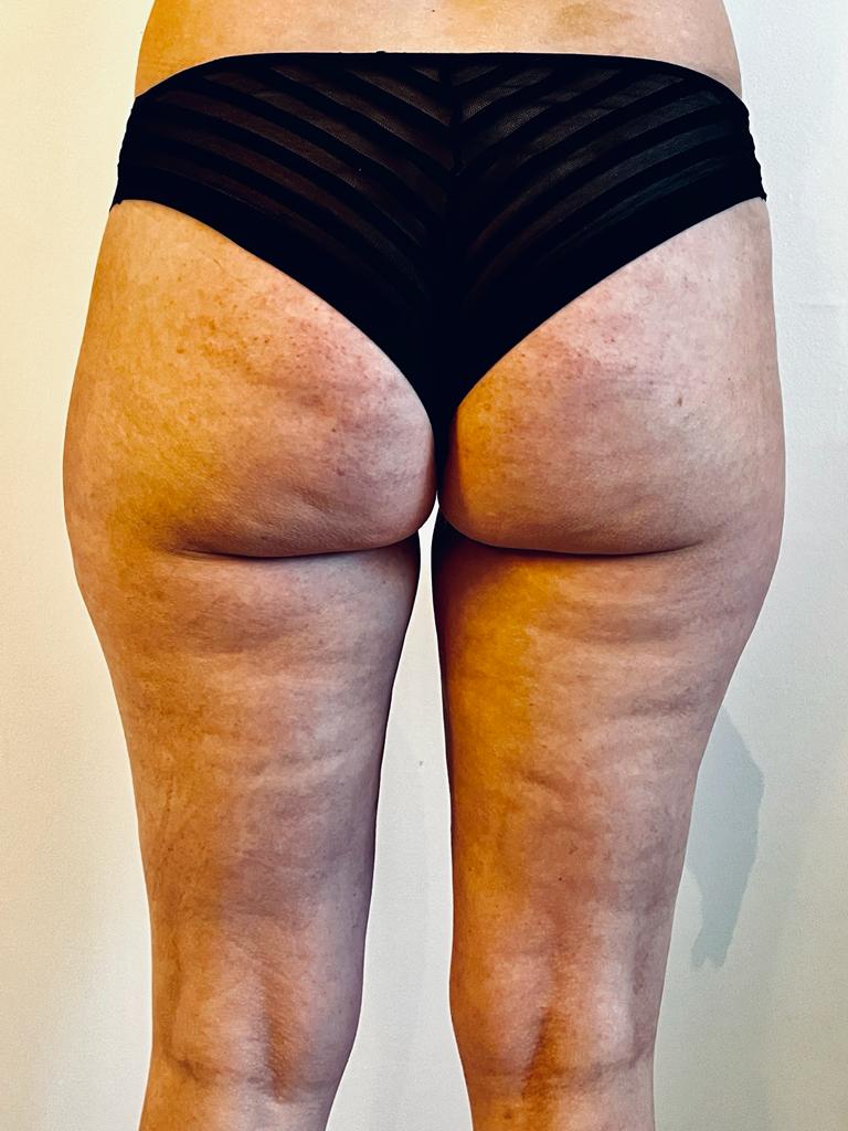 cupping, cellulitis, bindweefselmassage, transformeren, therapie, ontspanning, gezondheid, wellness, lichaamsbehandeling, zelfzorg, holistisch, spieren, rugpijn, nekpijn, stress, sportprestaties, genezing, acupunctuur, traditionele Chinese geneeskunde, energiestroom, littekens, bloedcirculatie, gifstoffen, immuunsysteem, verjonging, herstel, doorbloeding, massage, ontgifting, meridianen, ontsteking, pijnverlichting, alternatieve geneeskunde, natuurlijke genezing, helende kracht, chronische pijn, gezonde huid, vermoeidheid, slaapstoornissen, fibromyalgie, gewrichtspijn, menstruatiekrampen, spijsverteringsproblemen, hoofdpijn, migraine, allergieën, ademhaling, mindfulness, ontspanningstechnieken, meditatie, wellnesscentrum, cupping barneveld,benen