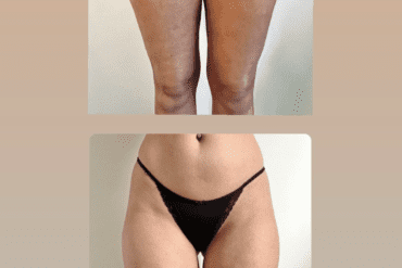 Ontdek de magie van Transformational Cupping voor een gladde huid en een gezonder lichaam
