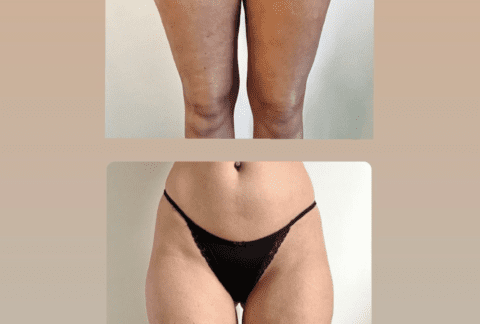 upping therapeut past behandeling toe op de rug van een patiënt